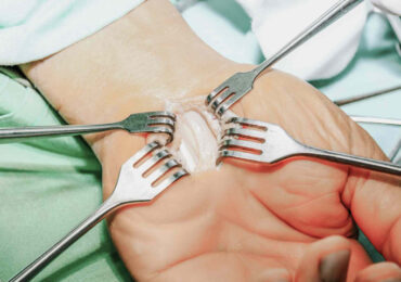 Carpal Tunnel Syndrome Surgery: Understanding Procedures, Risks & Recovery